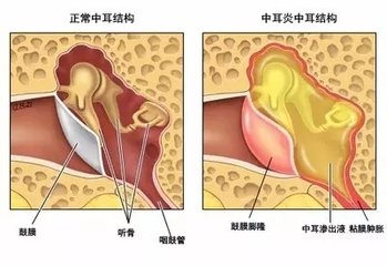感冒可导致中耳炎?是真的!严重者或直接损伤听力