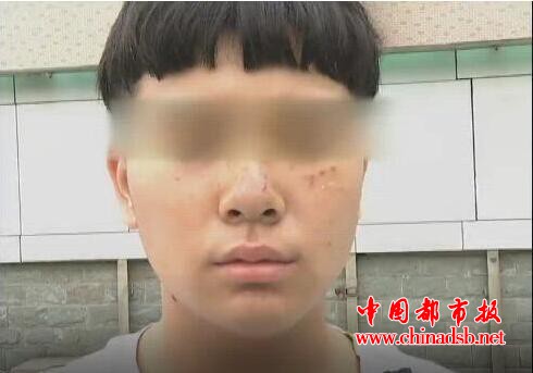 打篮球给人抓伤