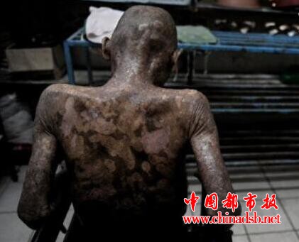 安吉拉·哈里斯传染了几个人：12年故意和多达100人发生关系